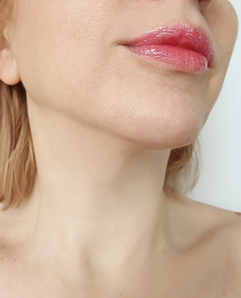 After EndoLift treatment